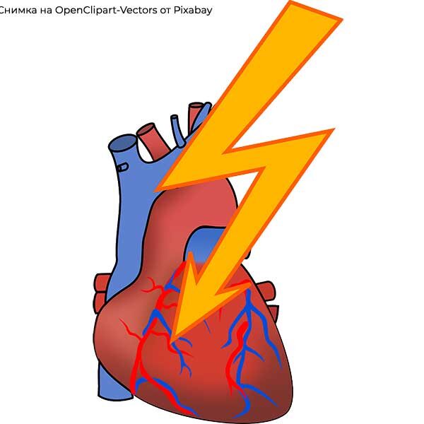сърдечен инфаркт